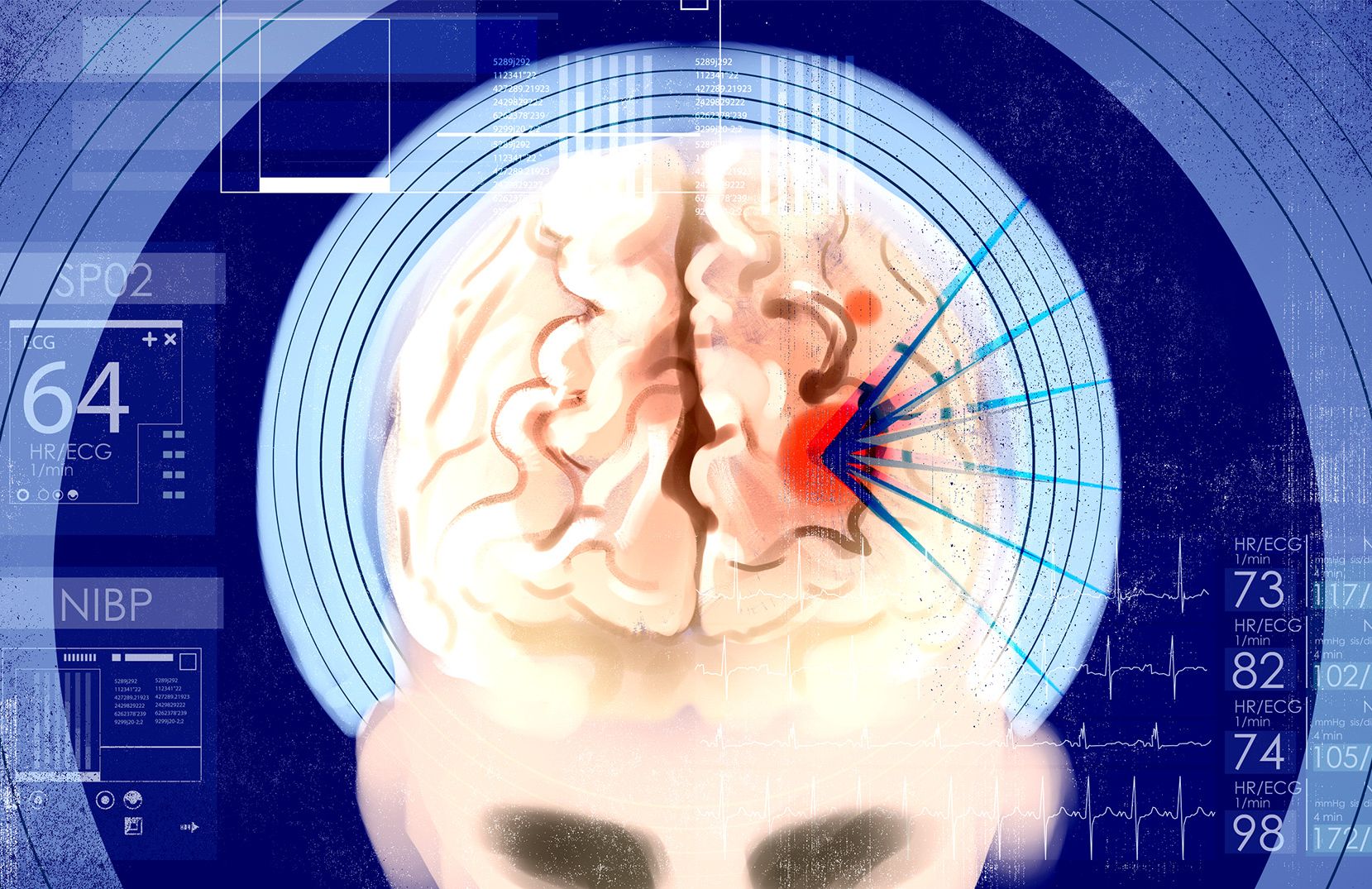 Ilustracja do tekstu o neurochirurgii bez skalpela