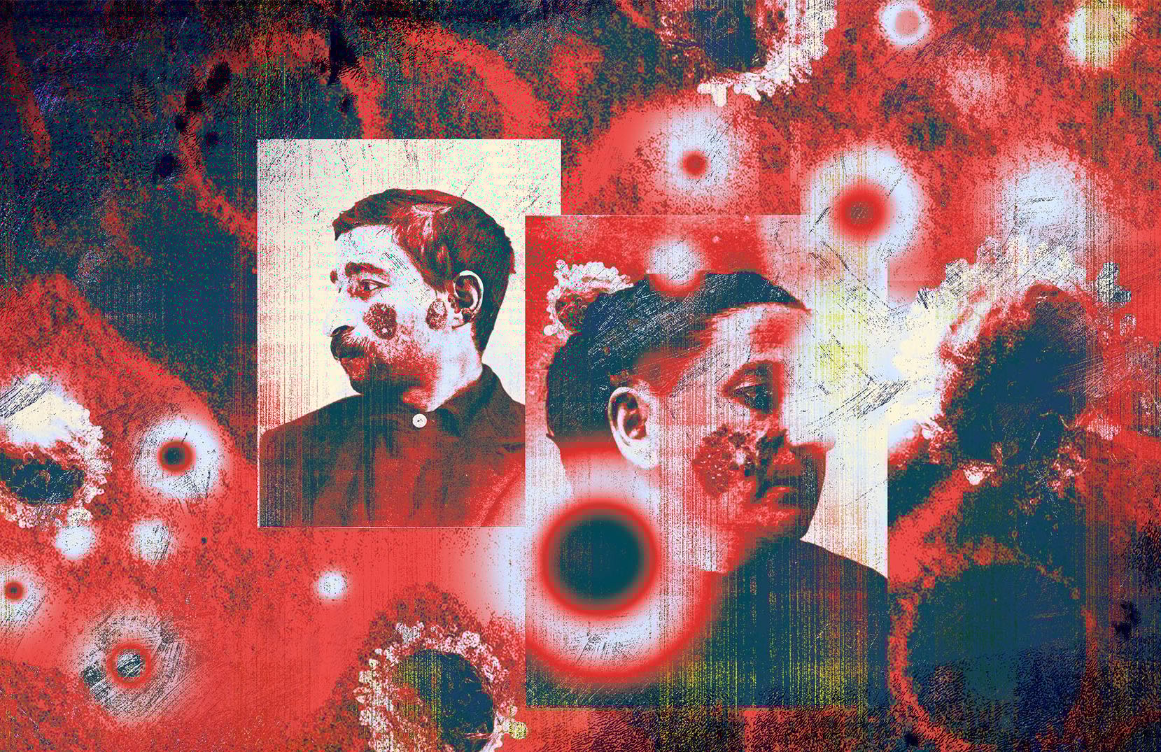 Il. tekstu o przyczynach choroby zwanej toczeń rumieniowaty