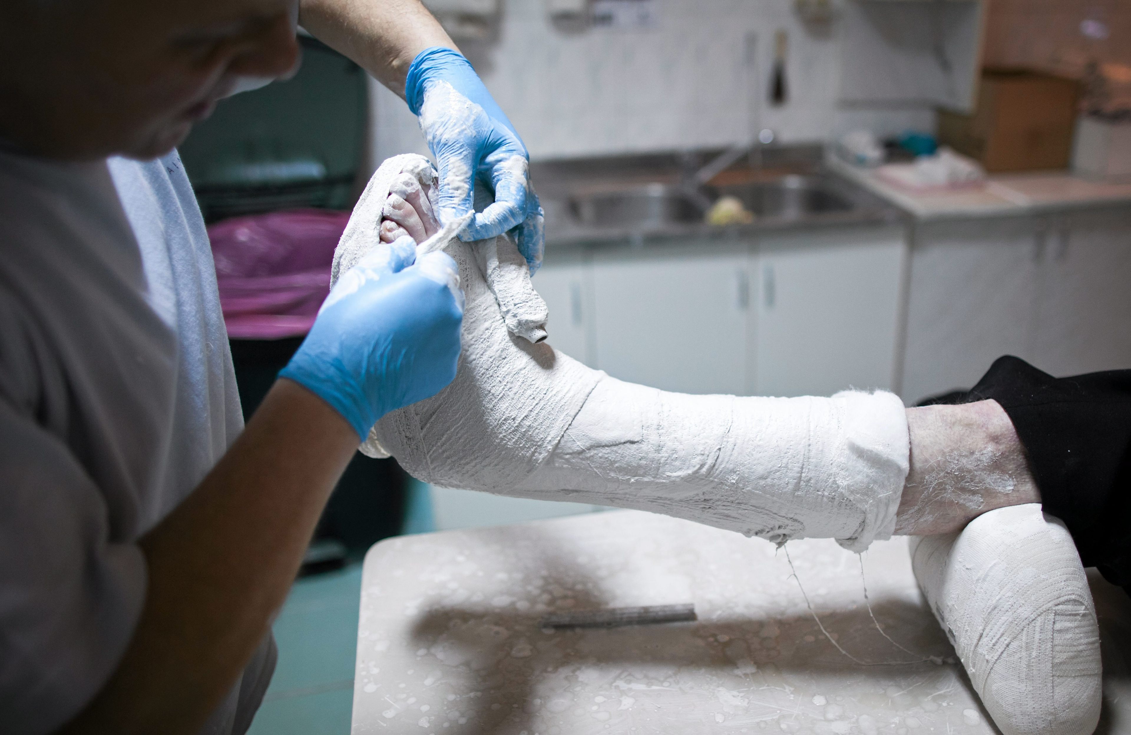 gips złamanie
