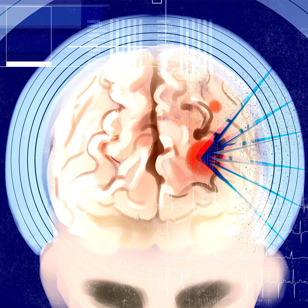 Ilustracja do tekstu o neurochirurgii bez skalpela
