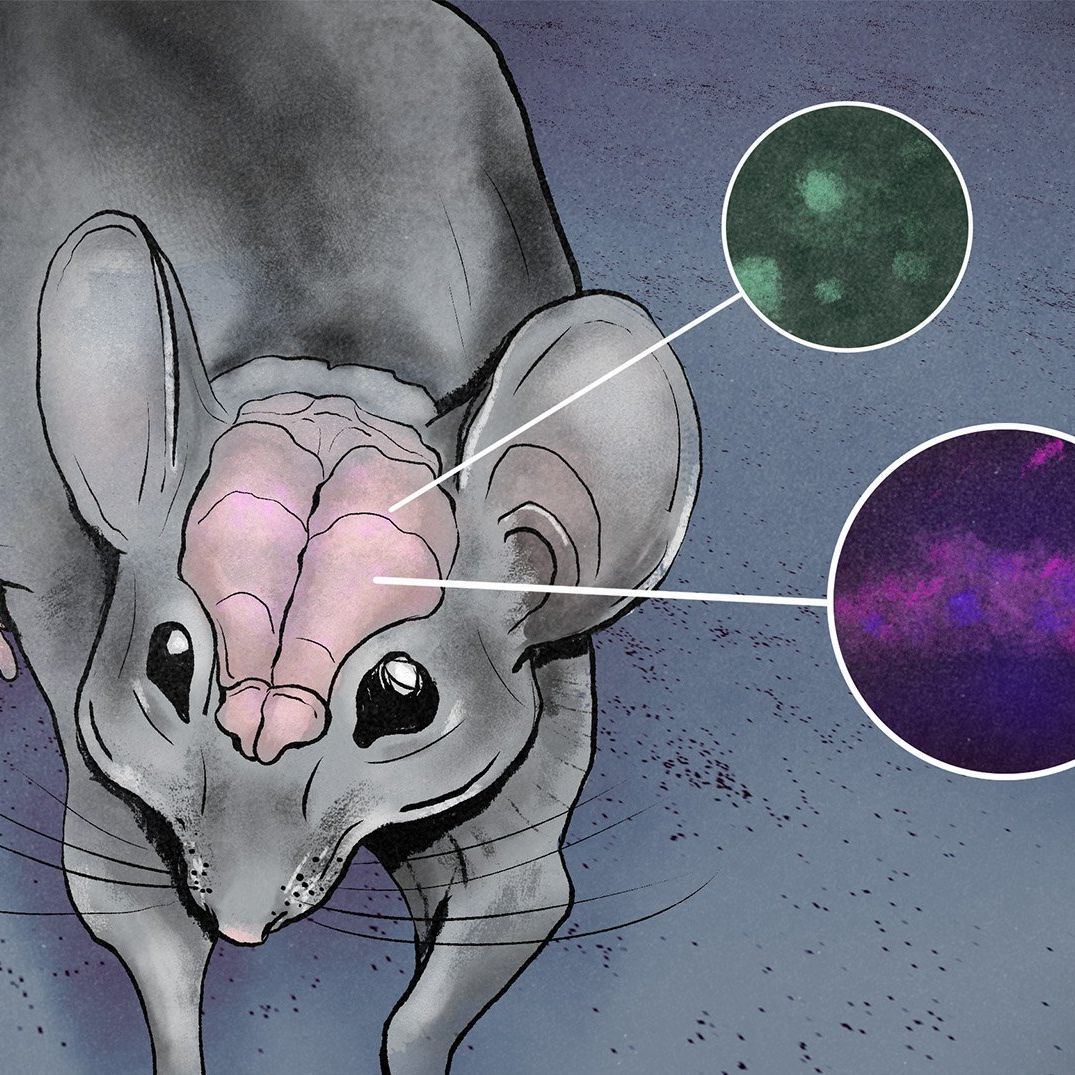 Ilustracja do tekstu o przyczynach alzheimera