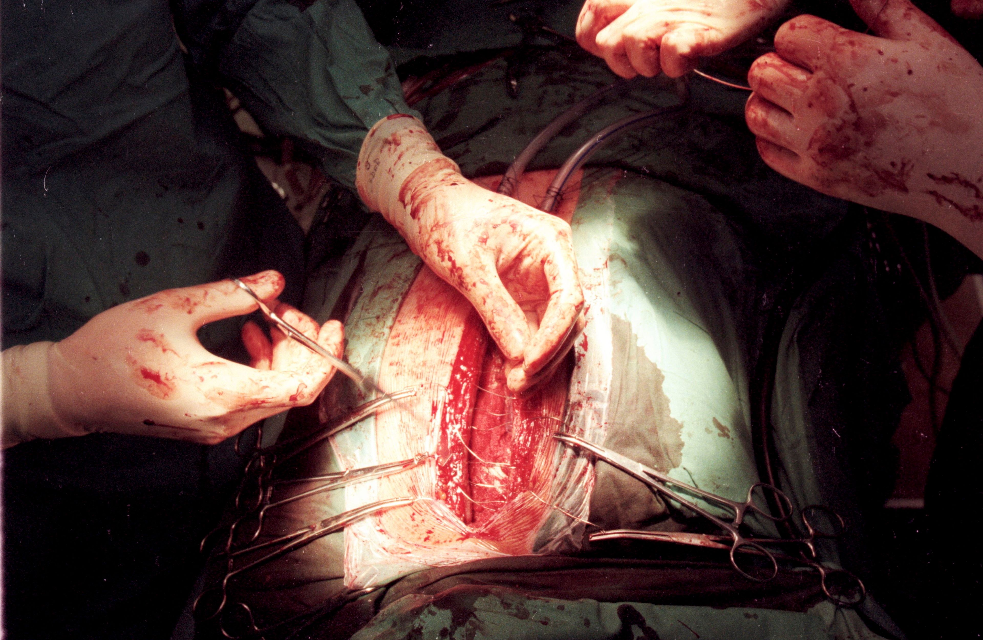 18.10.1996 Zabrze , Slaskie Centrum Chorob Serca . Transplantacja serca .
Fot. Robert Krzanowski / Agencja Wyborcza.pl