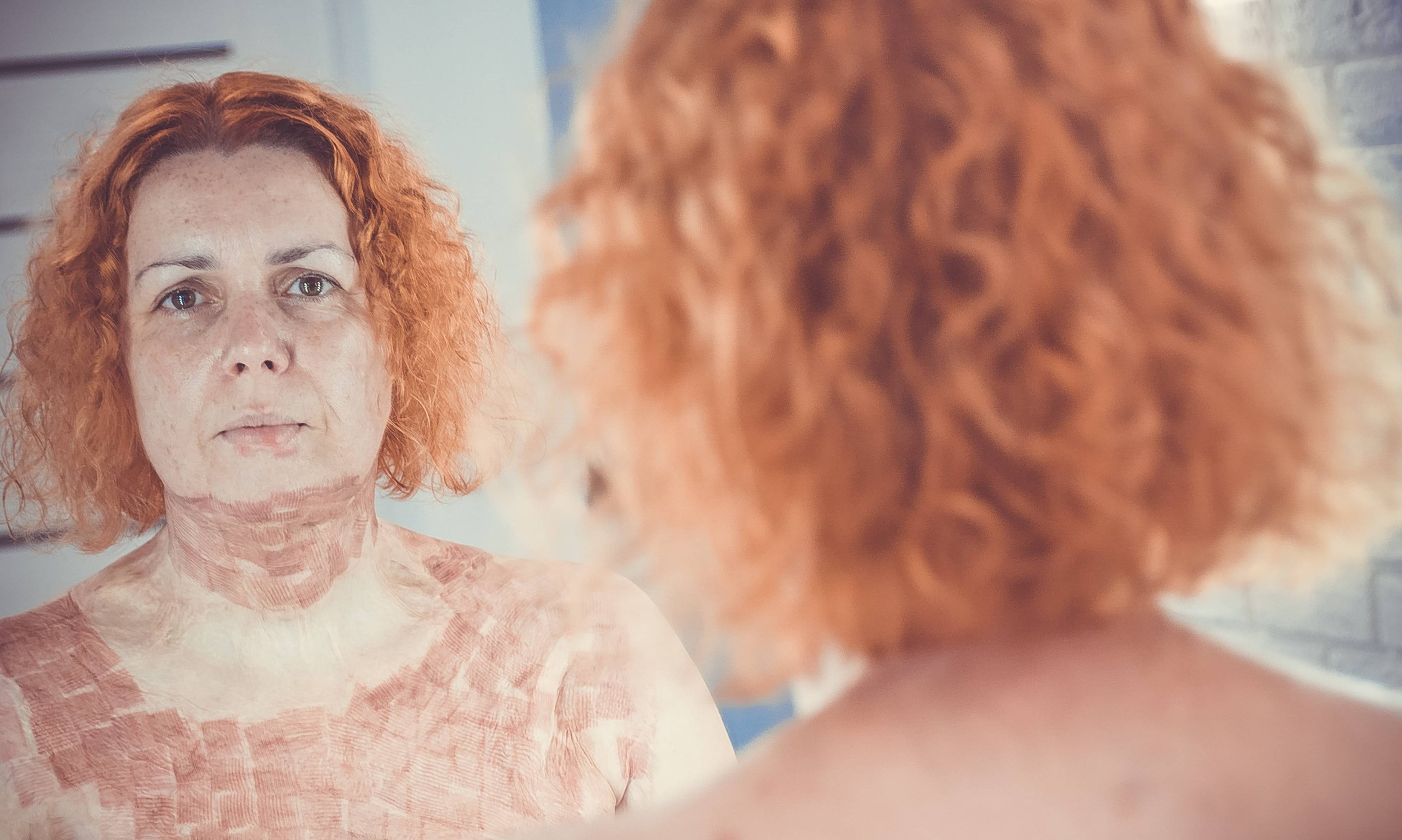 Portret poparzonej kobiety w lustrze