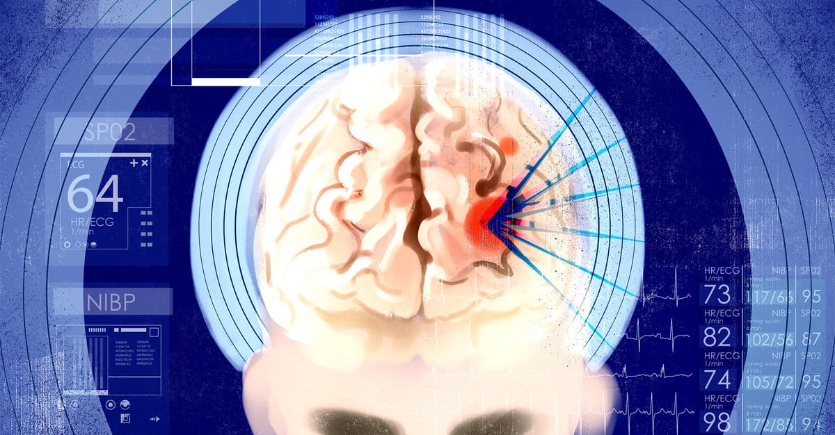 Operacje mózgu bez skalpela. Nadchodzi era bezinwazyjnej neurochirurgii?