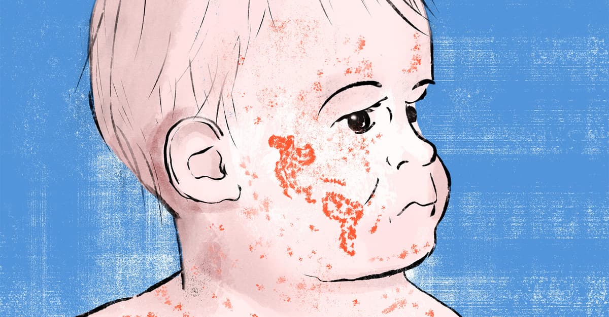 Świat przegrywa z odrą. To wirus, który nie wybacza zaniedbań