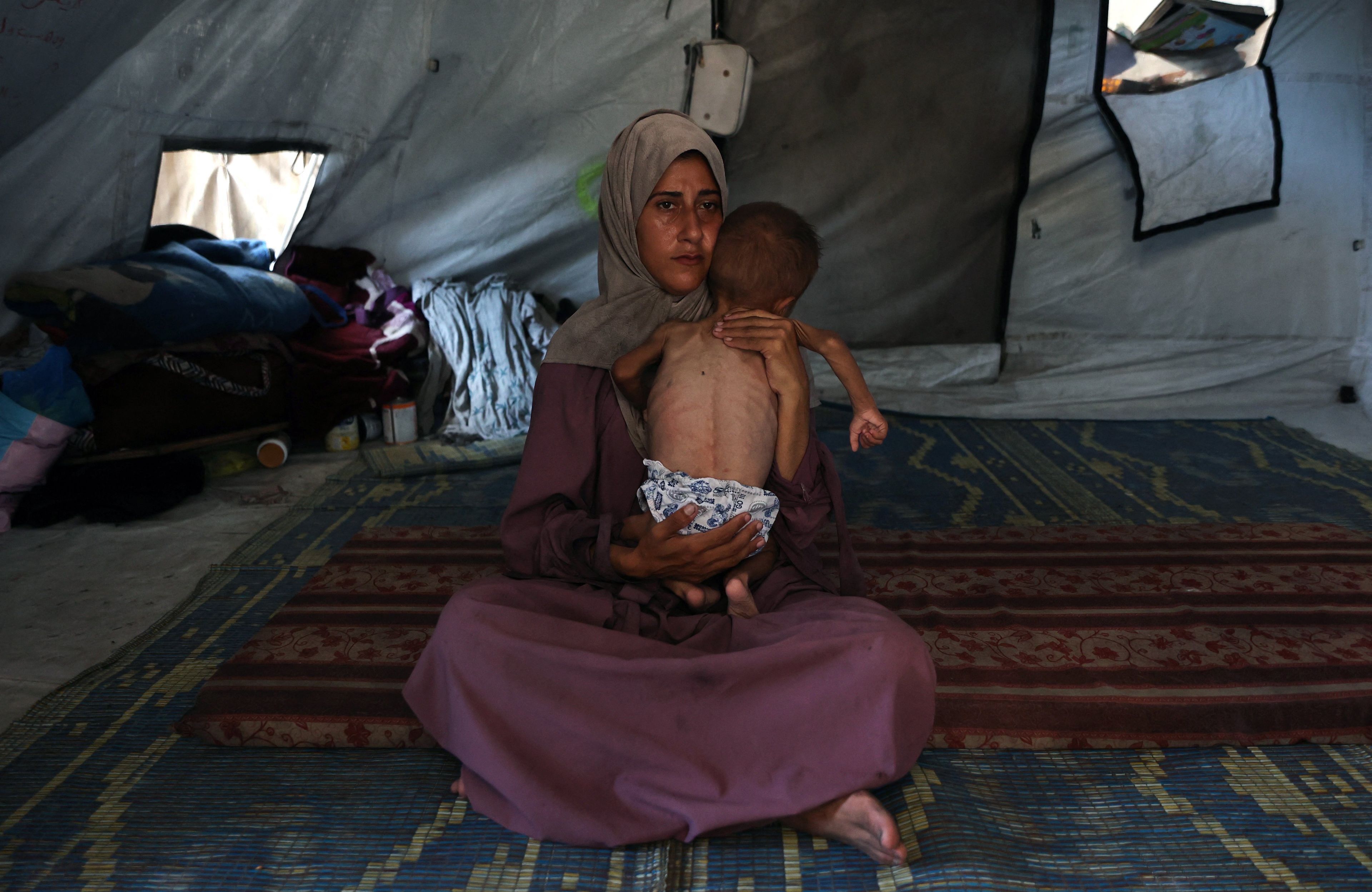 PALESTINIAN-ISRAEL-CONFLICT-MALNUTRITION