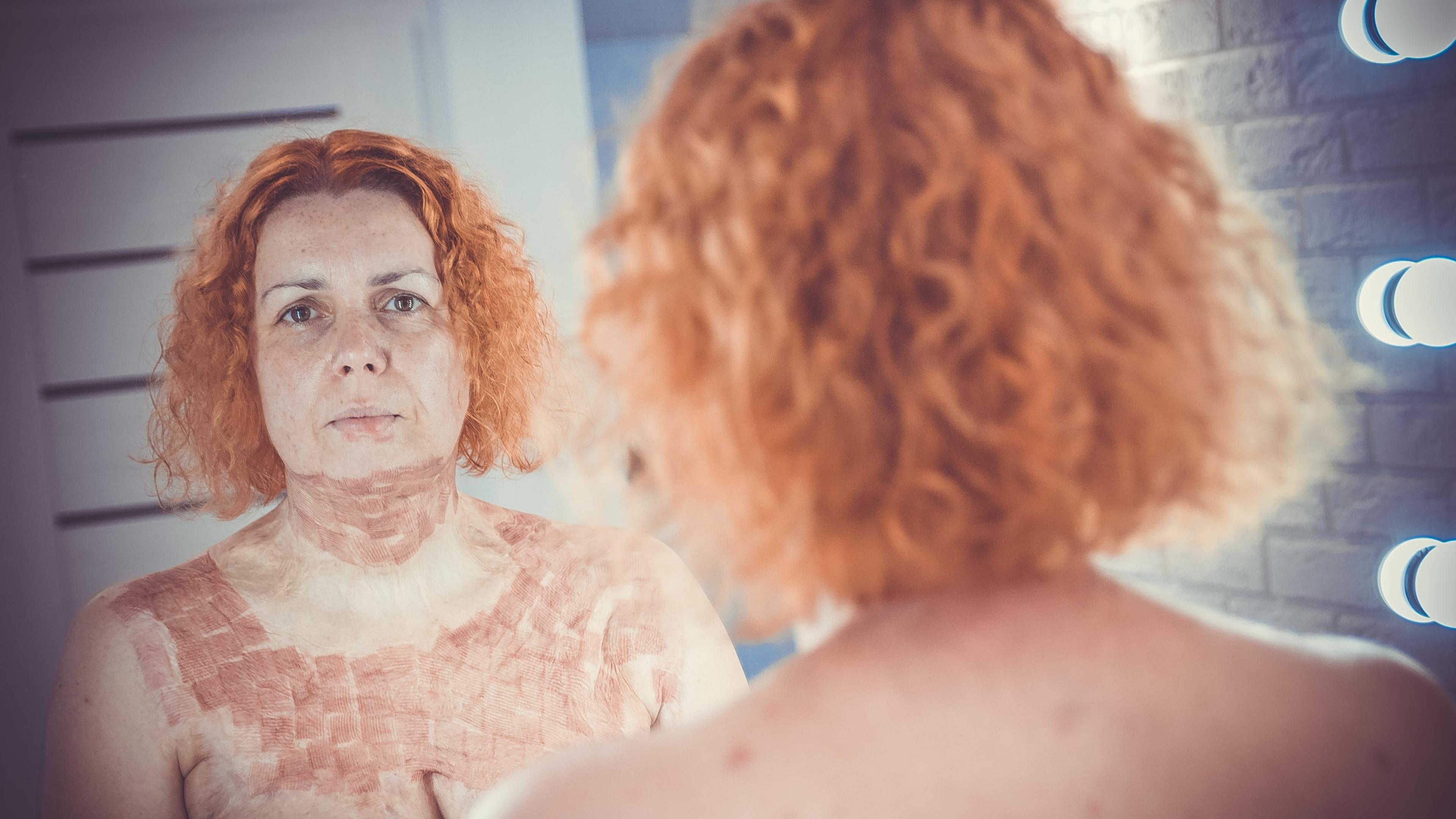 Portret poparzonej kobiety w lustrze