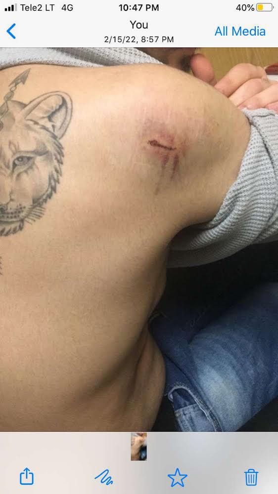 ślŚlady po pobiciu i po ugryzieniach na ciele jednej z uciekających osób, fot. mat. własne
